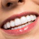 smiling woman wearing invisalign clear aligners