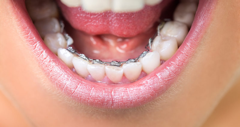 Lingual Braces: Cost, What They Are, vs. Invisalign & More