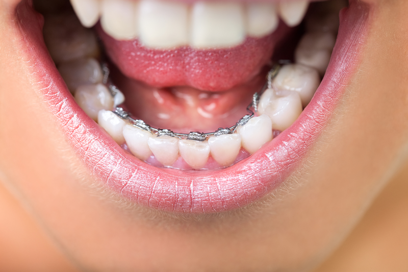 lingual braces woman with behind the teeth braces