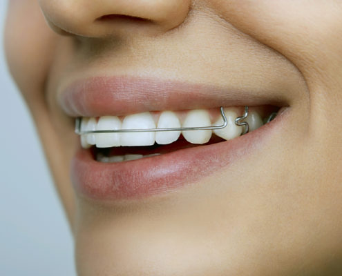 Smiling Girl Wearing Removable Vivera Retainer for Teeth