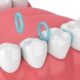 3D rendering of orthodontic teeth spacers aka separators